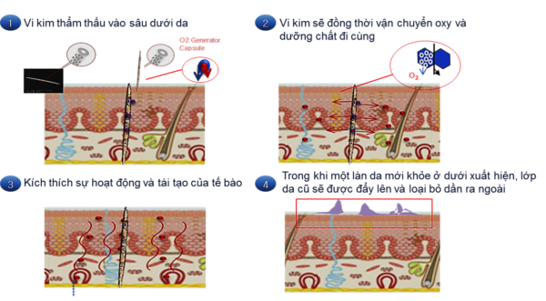Gia công Kem vi kim tảo biển - Thay da trẻ hóa cho Spa 4 cơ chế hoạt động kem vi kim