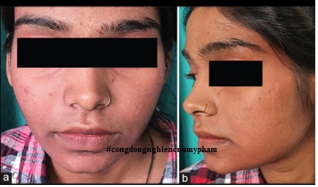 Gia công Kem trị nám tranexamic acid 10% 12 mặt bị ban đỏ cải thiện sau khi dùng Kem trị nám tranexamic acid 10% được gia công sản xuất bởi iFREE