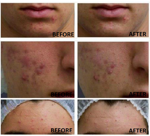 Gia công Serum trị mụn Tràm Trà 3 giảm mụn giảm thâm sau 7 ngày khi dùng serum trị mụn tràm trà được gia công bởi GefcoE, hình ảnh được cung cấp từ người kinh doanh mỹ phẩm và khách hàng của họ gửi tới Gefco