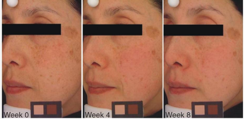 Gia công Serum vi kim 8 hiểu quả trị nám,đốm nâu sỉn màu vitamin b3, vitamin b3 là hoạt chất quan trọng trong công thức gia công mỹ phẩm