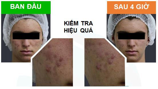 Gia công Kem mụn tràm trà 15 hiểu quả mụn sau 4 giờ