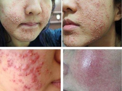 Gia công Essence cây hồi sinh 2 da bị kích ứng mỹ phẩm