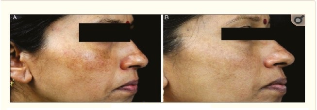 Gia công Kem trị nám tranexamic acid 10% 10 Hiệu quả của sản phẩm Gia công Kem trị nám tranexamic acid 10% có chứa hydroquinone 3% tác dụng làm mờ nám