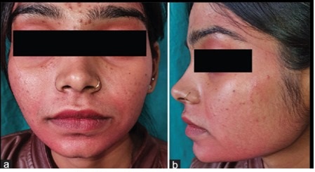 Gia công Kem trị nám tranexamic acid 10% 11 mặt bị ban đỏ trước khi dùng Kem trị nám tranexamic acid 10% được gia công sản xuất bởi iFREE